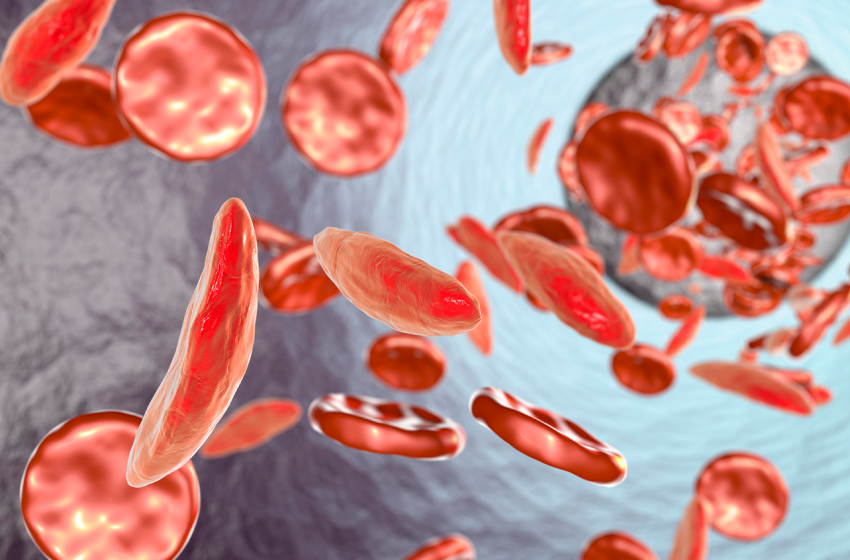 Do You Know The Correlation Between Sickle Cell Anemia and Covid-19?